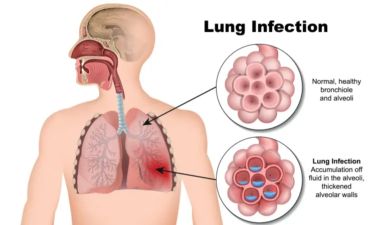 WBBSE Notes For Class 8 General Science And Environment Chapter 5 Analysis Of Natural Phenomena Infected Lung