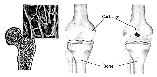WBBSE Notes For Class 6 General Science And Environment Chapter 8 The Human Body Osteoporosis and Osteoarthritis